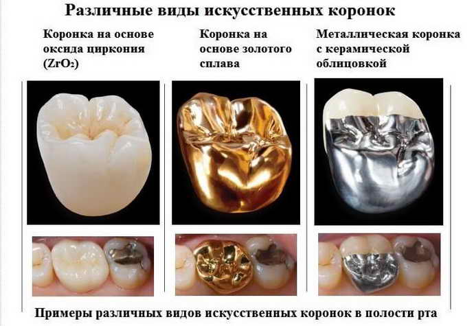 Из каких материалов делают коронки зубов?
